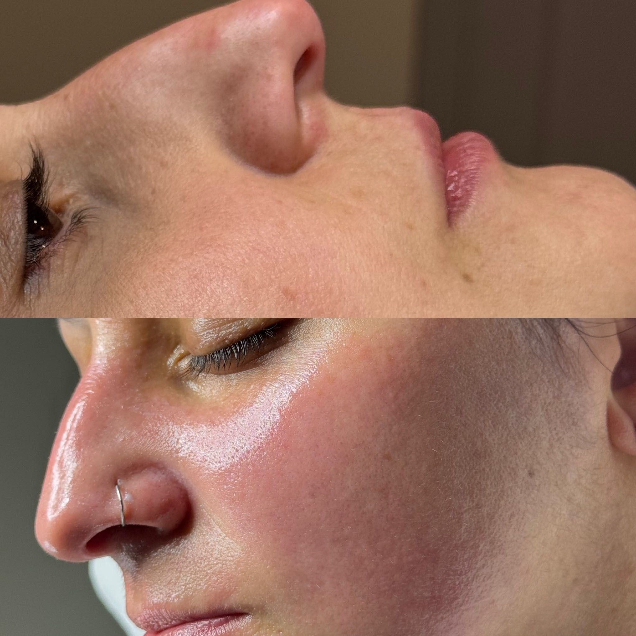 Resultado tratamiento facial - Antes y después en NILA Space Palma