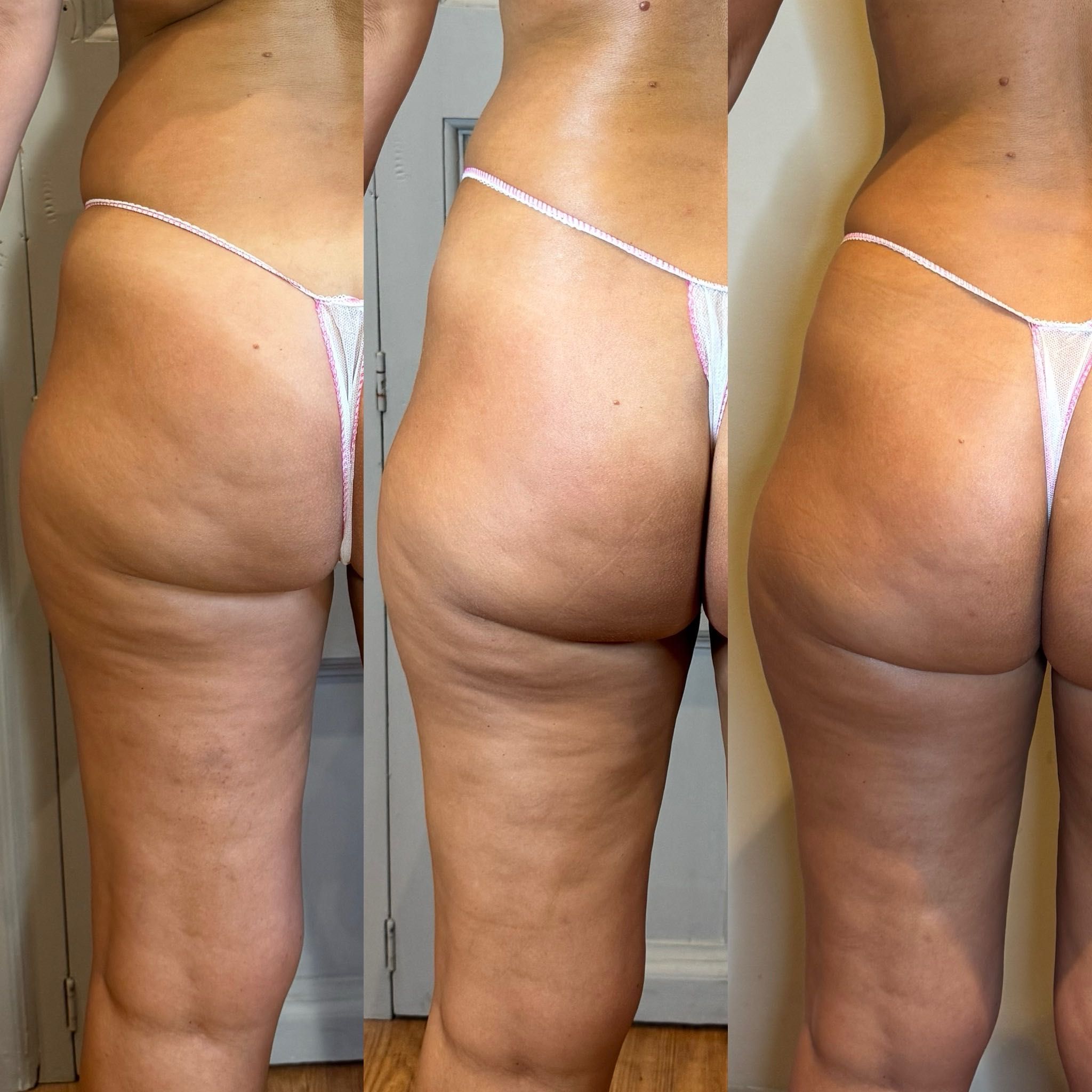 Resultado tratamiento corporal - Transformación en NILA Space Mallorca